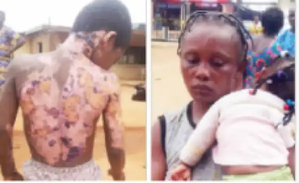 Nursing mother sets 10 year old brother-in-law ablaze in Lagos